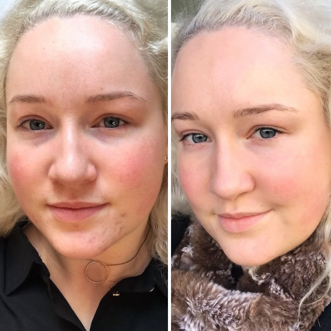 Frau mit heller Haut in nebeneinanderliegenden Selfies, ihr Teint hat sich nach BB PERFECT SKIN & GLOW Online Kurs verbessert. Blashy Shop