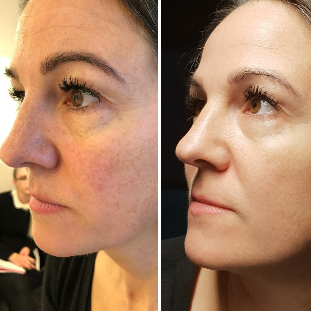 Die Ergebnisse zeigen eine glattere Haut und weniger Rötungen nach dem BB PERFECT SKIN & GLOW Online Kurs von Lash&Brow Academy. Blashy Shop